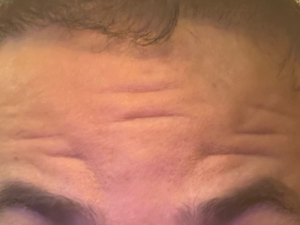Botox: antes