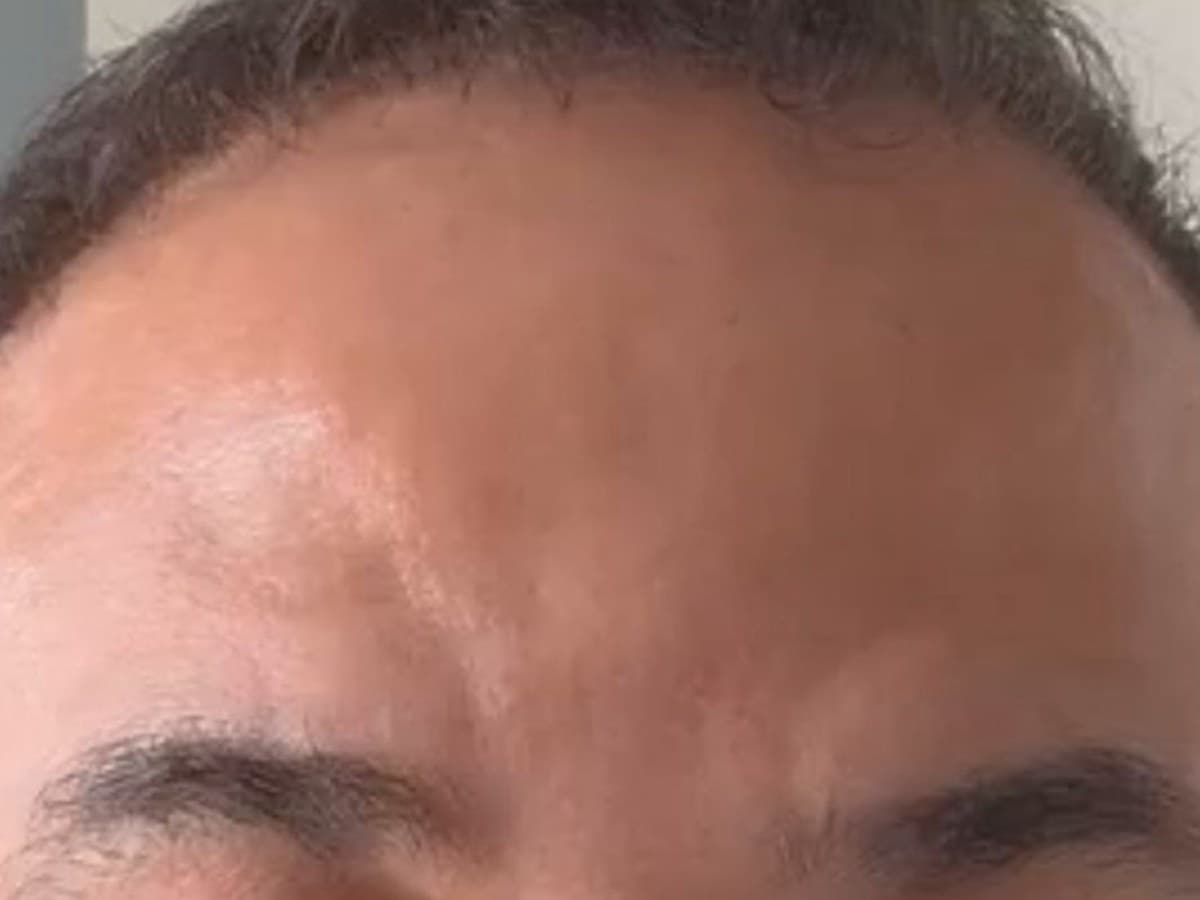 Botox: depois