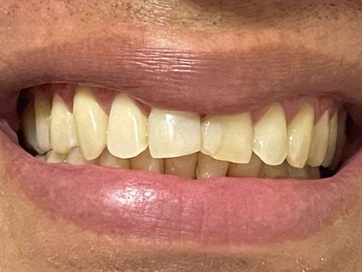 Sorriso mais claro: antes