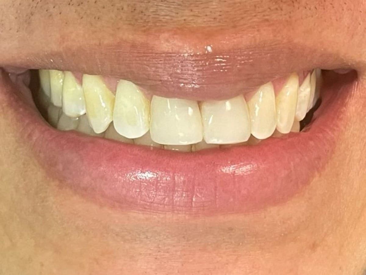 Sorriso mais claro: depois