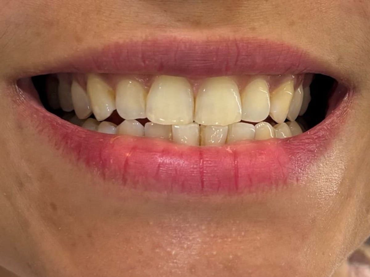 Harmonia do sorriso: antes