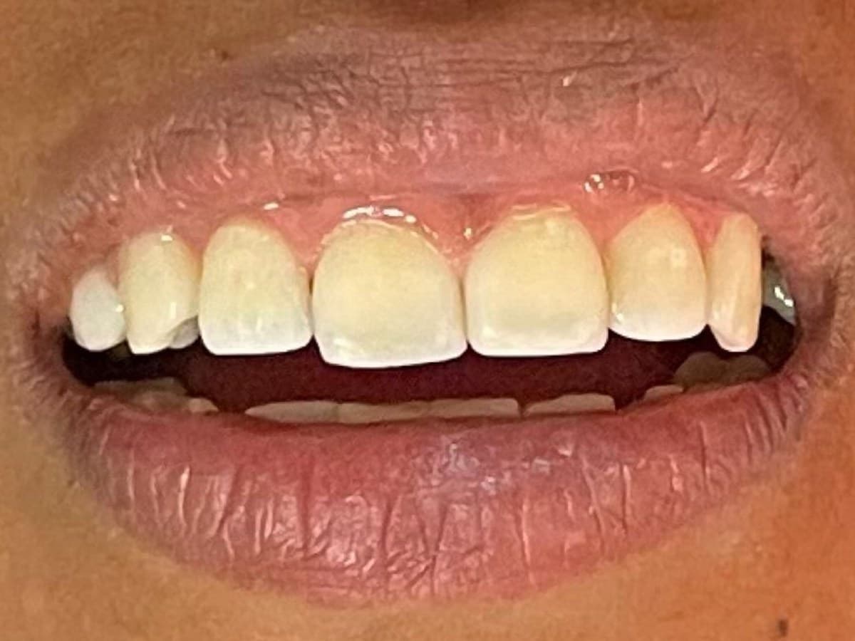 Reanatomização dental: depois