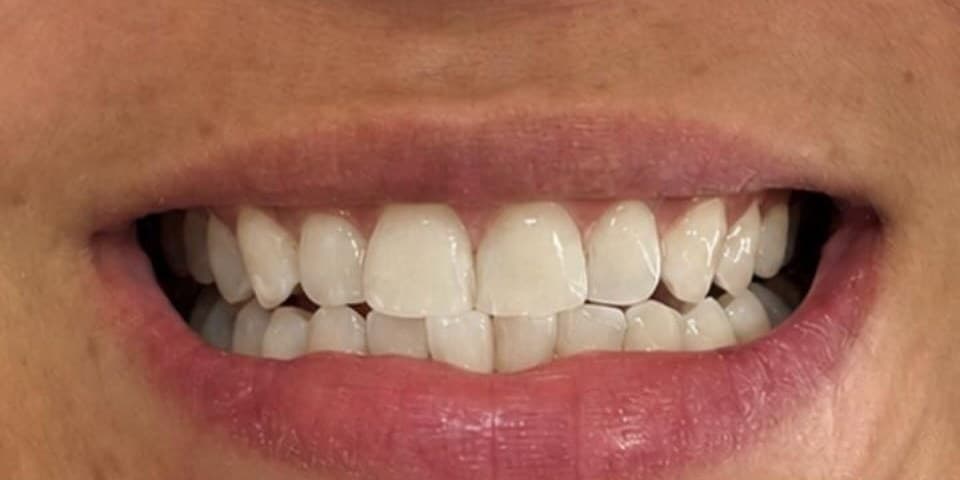 Sorriso após clareamento dental